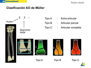 Radio distal
Clasificación AO de Müller
Segmento
distal
Hueso
-
2 3
Tipo B
Tipo A
Tipo A : Extra-articular
Tipo B : Articular parcial
Tipo C : Articular completa
Tipo C
 