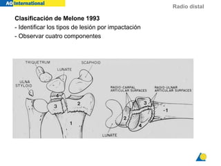 Radio distal
Clasificación de Melone 1993
- Identificar los tipos de lesión por impactación
- Observar cuatro componentes
 