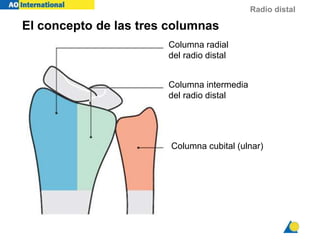 Radio distal
El concepto de las tres columnas
Rikli, Regazzoni
J Bone Joint Surg 1996
Columna radial
del radio distal
Columna intermedia
del radio distal
Columna cubital (ulnar)
 