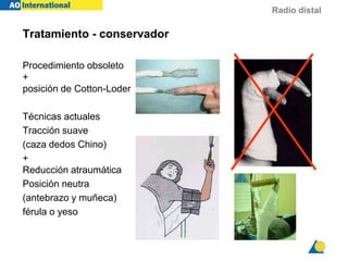 Radio distal
Tratamiento - conservador
Procedimiento obsoleto
+
posición de Cotton-Loder
Técnicas actuales
Tracción suave
(caza dedos Chino)
+
Reducción atraumática
Posición neutra
(antebrazo y muñeca)
férula o yeso
 
