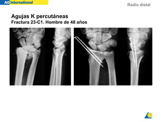 Radio distal
Agujas K percutáneas
Fractura 23-C1. Hombre de 48 años
 