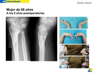 Radio distal
Mujer de 66 años
A los 2 años postoperatorios
 