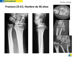 Radio distal
Fractura 23-C3, Hombre de 58 años
 