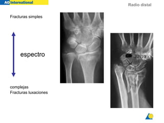 Radio distal
Fracturas simples
complejas
Fracturas luxaciones
espectro
 