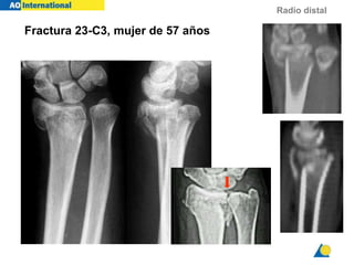 Radio distal
KF 57y f
Fractura 23-C3, mujer de 57 años
 