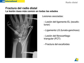 Radio distal
Fractura del radio distal
La lesión ósea más común en todas las edades
Lesiones asociadas:
- Lesión del ligamento EL (escafo-
lunar)
- Ligamento LG (lunato-ganchoso)
i
- Lesión del fibrocartílago
triangular (FCT)
- Fractura del escafoides
 