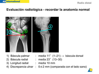 Radio distal
Evaluación radiológica - recordar la anatomía normal
1) Báscula palmar : media 11°(1–21) → báscula dorsal
2) Báscula radial : media 23°(13–30)
3) Longitud radial : media 10 mm
4) Discrepancia ulnar : 0±2 mm (comparada con el lado sano)
1
2
3 4
 
