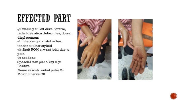 pain joint paracetamol for fracture case dicussion colles'