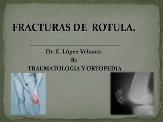 FRACTURAS DE  ROTULA. __________________ Dr. E. López Velasco. R1  TRAUMATOLOGIA Y ORTOPEDIA 