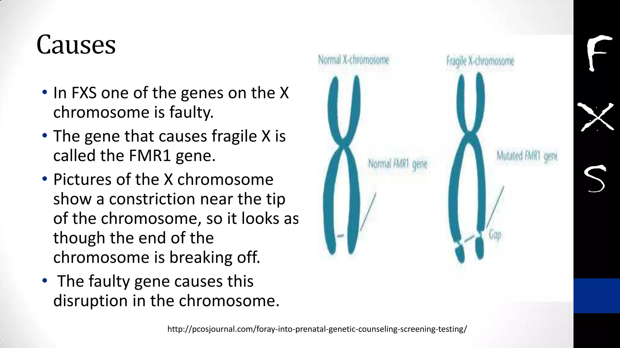 Causes
• In FXS one of the genes on the X
chromosome is faulty.
• The gene that causes fragile X is
called the FMR1 gene.
• Pictures of the X chromosome
show a constriction near the tip
of the chromosome, so it looks as
though the end of the
chromosome is breaking off.
• The faulty gene causes this
disruption in the chromosome.
http://pcosjournal.com/foray-into-prenatal-genetic-counseling-screening-testing/
 