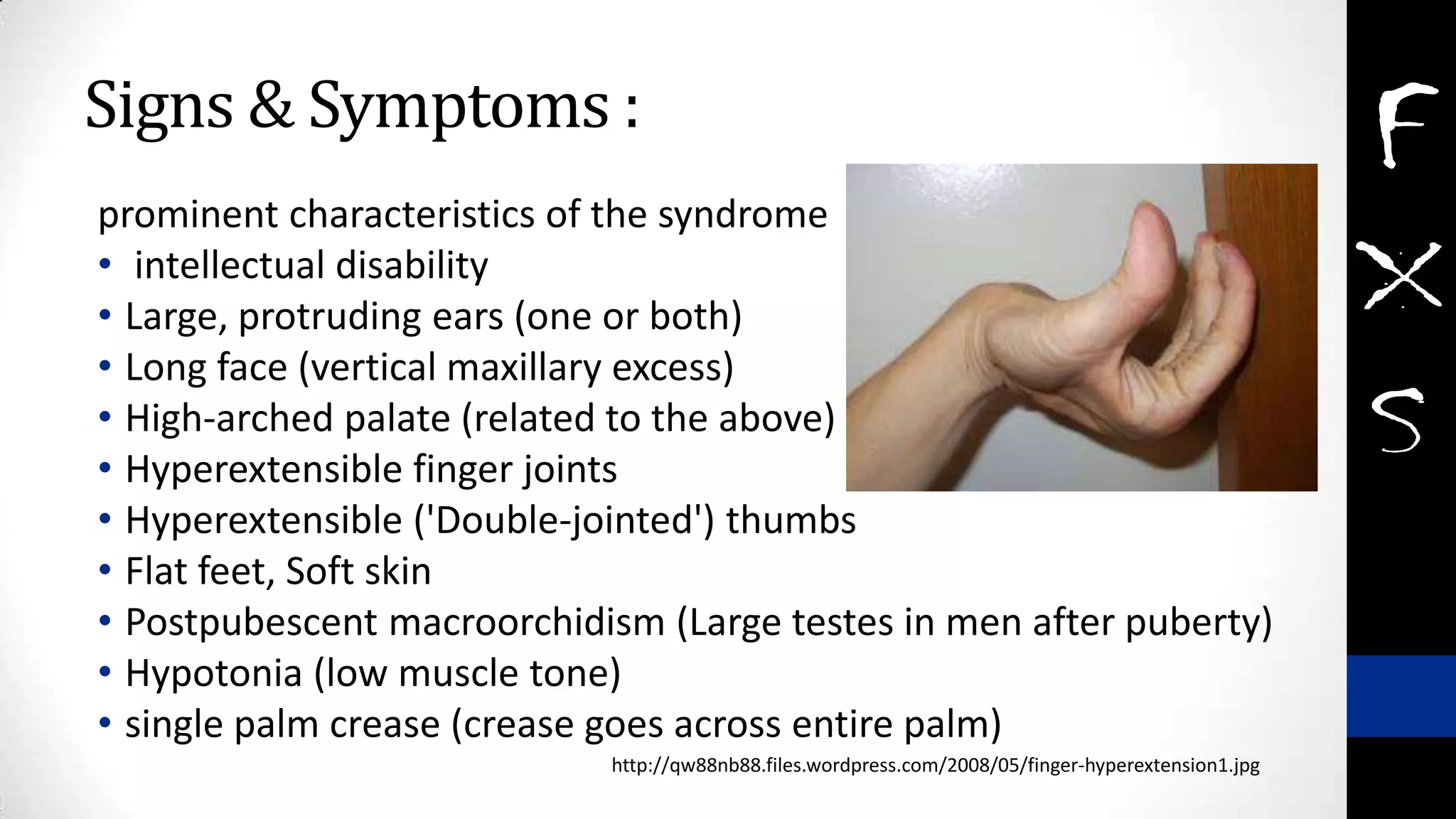 Signs & Symptoms :
prominent characteristics of the syndrome
• intellectual disability
• Large, protruding ears (one or both)
• Long face (vertical maxillary excess)
• High-arched palate (related to the above)
• Hyperextensible finger joints
• Hyperextensible ('Double-jointed') thumbs
• Flat feet, Soft skin
• Postpubescent macroorchidism (Large testes in men after puberty)
• Hypotonia (low muscle tone)
• single palm crease (crease goes across entire palm)
http://qw88nb88.files.wordpress.com/2008/05/finger-hyperextension1.jpg
 
