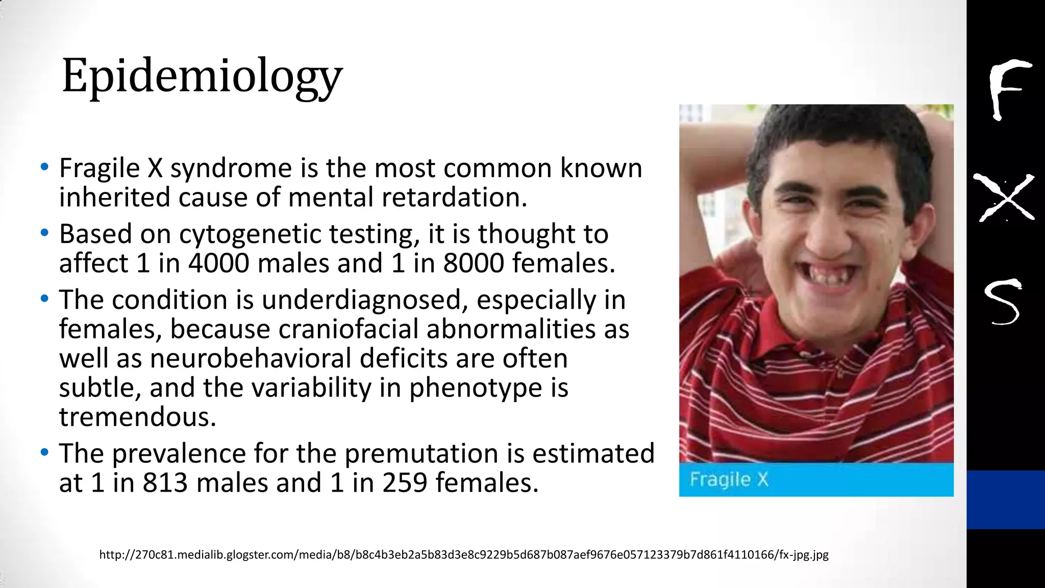 Epidemiology
• Fragile X syndrome is the most common known
inherited cause of mental retardation.
• Based on cytogenetic testing, it is thought to
affect 1 in 4000 males and 1 in 8000 females.
• The condition is underdiagnosed, especially in
females, because craniofacial abnormalities as
well as neurobehavioral deficits are often
subtle, and the variability in phenotype is
tremendous.
• The prevalence for the premutation is estimated
at 1 in 813 males and 1 in 259 females.
http://270c81.medialib.glogster.com/media/b8/b8c4b3eb2a5b83d3e8c9229b5d687b087aef9676e057123379b7d861f4110166/fx-jpg.jpg
 
