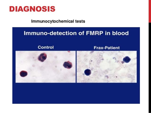 test fragile x results blood Fragile Syndrome X