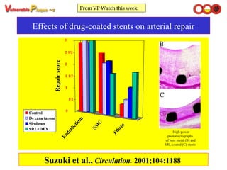 Effects of drug-coated stents on arterial repair
Suzuki et al., Circulation. 2001;104:1188
Endothelium
SM
C
Fibrin
0
1/2
1
1 1/2
2
2 1/2
3
Repairscore
Control
Dexametasone
Sirolimus
SRL+DEX
From VP Watch this week:
High-power
photomicrographs
of bare metal (B) and
SRL-coated (C) stents
 
