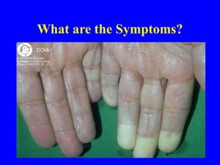 What are the Symptoms?
 