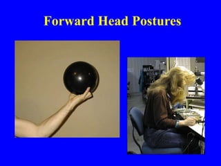 Forward Head Postures
 