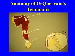 Anatomy of DeQuervain’s
Tendonitis
 