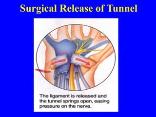 Surgical Release of Tunnel
 