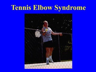 Tennis Elbow Syndrome
 