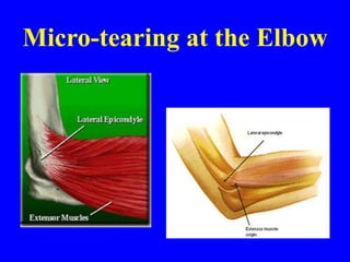 Micro-tearing at the Elbow
 