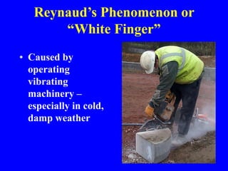 Reynaud’s Phenomenon or
“White Finger”
• Caused by
operating
vibrating
machinery –
especially in cold,
damp weather
 