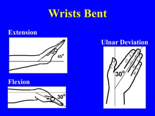 Wrists Bent
Extension
Ulnar Deviation
Flexion
 