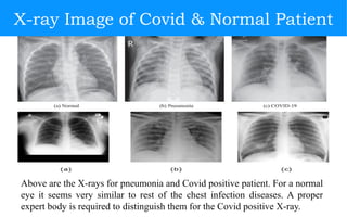 Covid Detectioin via X-ray Image Processing | PPTX