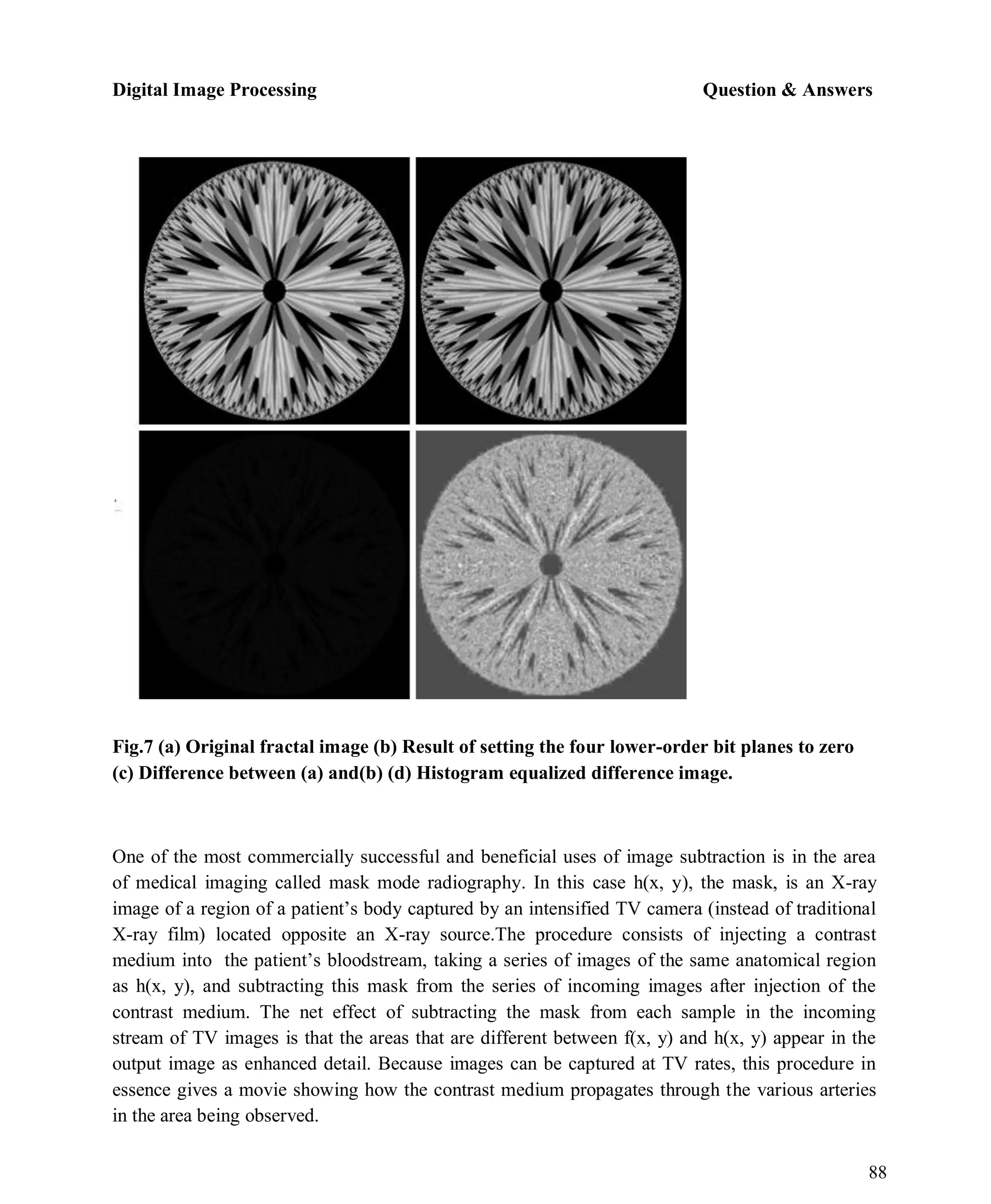 Digital Image Processing Question & Answers
88
Fig.7 (a) Original fractal image (b) Result of setting the four lower-order bit planes to zero
(c) Difference between (a) and(b) (d) Histogram equalized difference image.
One of the most commercially successful and beneficial uses of image subtraction is in the area
of medical imaging called mask mode radiography. In this case h(x, y), the mask, is an X-ray
image of a region of a patient’s body captured by an intensified TV camera (instead of traditional
X-ray film) located opposite an X-ray source.The procedure consists of injecting a contrast
medium into the patient’s bloodstream, taking a series of images of the same anatomical region
as h(x, y), and subtracting this mask from the series of incoming images after injection of the
contrast medium. The net effect of subtracting the mask from each sample in the incoming
stream of TV images is that the areas that are different between f(x, y) and h(x, y) appear in the
output image as enhanced detail. Because images can be captured at TV rates, this procedure in
essence gives a movie showing how the contrast medium propagates through the various arteries
in the area being observed.
 
