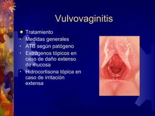 Vulvovaginitis Tratamiento Medidas generales ATB según patógeno Estrógenos tópicos en caso de daño extenso de mucosa Hidrocortisona tópica en caso de irritación extensa 