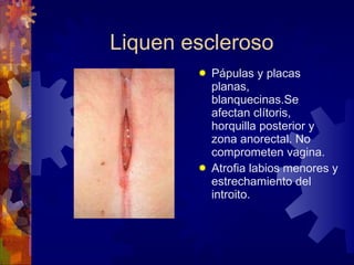 Liquen escleroso Pápulas y placas planas, blanquecinas.Se afectan clítoris, horquilla posterior y zona anorectal. No comprometen vagina.  Atrofia labios menores y estrechamiento del introito. 
