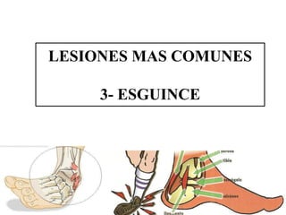 LESIONES MAS COMUNES
3- ESGUINCE
 