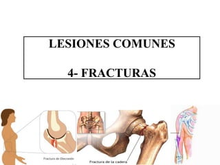LESIONES COMUNES
4- FRACTURAS
 