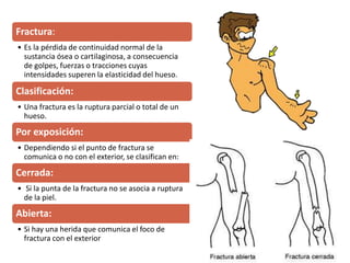 Fractura:
• Es la pérdida de continuidad normal de la
sustancia ósea o cartilaginosa, a consecuencia
de golpes, fuerzas o tracciones cuyas
intensidades superen la elasticidad del hueso.
Clasificación:
• Una fractura es la ruptura parcial o total de un
hueso.
Por exposición:
• Dependiendo si el punto de fractura se
comunica o no con el exterior, se clasifican en:
Cerrada:
• Si la punta de la fractura no se asocia a ruptura
de la piel.
Abierta:
• Si hay una herida que comunica el foco de
fractura con el exterior
 
