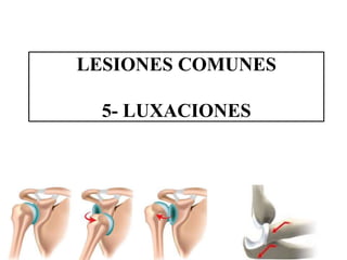 LESIONES COMUNES
5- LUXACIONES
 