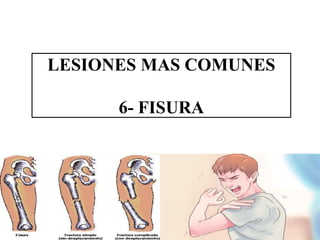 LESIONES MAS COMUNES
6- FISURA
 