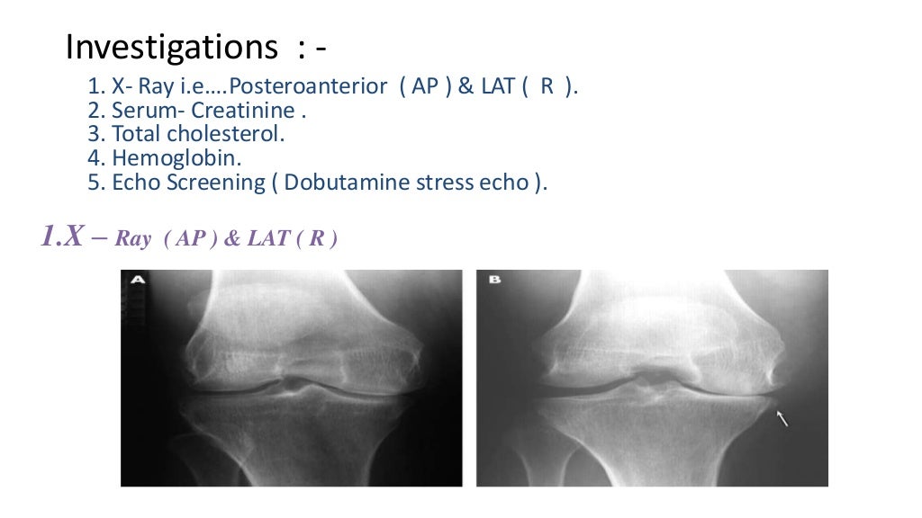 A Case study on OSTEOARTHRITIS by NOM