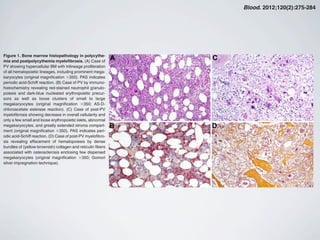 pathway.44,45 Patients with primary familial and congenital polycy-
themia have isolated erythrocytosis, low EPO, no splenomegaly,
and a predisposition to severe cardiovascular (CV) problems.45 On
the other hand, the oxygen-sensing pathway consists of different
proteins involved in the regulation of erythropoietin production:
Risk factors for thrombosis
There is a general agreement among investigators to consider age
older than 60 years at diagnosis and a history of vascular events as
the 2 prognostic risk factors for thrombosis in PV (Table 3).54,55 The
European Collaboration on Low-Dose Aspirin in Polycythemia
Figure 1. Bone marrow histopathology in polycythe-
mia and postpolycythemia myeloﬁbrosis. (A) Case of
PV showing hypercellular BM with trilineage proliferation
of all hematopoietic lineages, including prominent mega-
karyocytes (original magniﬁcation ϫ350). PAS indicates
periodic acid-Schiff reaction. (B) Case of PV by immuno-
histochemistry revealing red-stained neutrophil granulo-
poiesis and dark-blue nucleated erythropoietic precur-
sors as well as loose clusters of small to large
megakaryocytes (original magniﬁcation ϫ350; AS-D-
chloroacetate esterase reaction). (C) Case of post-PV
myeloﬁbrosis showing decrease in overall cellularity and
only a few small and loose erythropoietic islets, abnormal
megakaryocytes, and greatly extended stroma compart-
ment (original magniﬁcation ϫ350). PAS indicates peri-
odic acid-Schiff reaction. (D) Case of post-PV myeloﬁbro-
sis revealing effacement of hematopoiesis by dense
bundles of (yellow-brownish) collagen and reticulin ﬁbers
associated with osteosclerosis enclosing few dispersed
megakaryocytes (original magniﬁcation ϫ350; Gomori
silver impregnation technique).
POLYCYTHEMIA VERA 277BLOOD, 12 JULY 2012 ⅐ VOLUME 120, NUMBER 2
For personal use only.by guest on August 15, 2013.bloodjournal.hematologylibrary.orgFrom
Blood. 2012;120(2):275-284
 