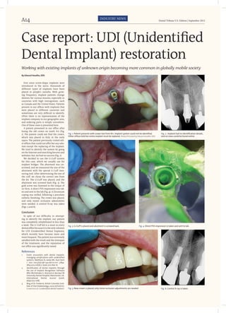 Dental Tribune U.S. Edition | September 2012A14 INDUSTRY NEWS
Case report: UDI (Unidentified
Dental Implant) restoration
By Edward Hoodfar, DDS
Ever since screw-shape implants were
introduced in the 1970s, thousands of
different types of implants have been
placed in people’s mouths. With grow-
ing frequency, implant patients change
dentists for various reasons, especially in
countries with high immigration, such
as Canada and the United States. Patients
present in our offices with implants that
were placed in different countries and
sometimes are very difficult to identify.
Often there is no representation of the
implant company in our geographic area,
and ordering parts is simply unrealistic.
One of these cases is presented here.
A patient presented in our office after
losing the old crown on tooth #11 (Fig.
1). The patient could not find the crown,
which was placed in Italy in the early
1990s. The patient previously visited oth-
er offices that could not offer her any solu-
tion except the replacing of the implant.
We tried to identify the system by going
on the Internet and searching forums and
websites; but, we had no success (Fig. 2).
We decided to use the G-Cuff system
for this case, which we usually use for
implant bridges. The abutment was un-
screwed, and we measured the size of the
abutment with the special G-Cuff mea-
suring tool. After determining the size of
the cuff, we chose the correct one from
the kit. The G-Cuff was placed, and the
abutment was screwed back (Fig. 3). The
gold screw was fastened to the torque of
20 Ncm. A direct PVS impression was tak-
en and sent to the lab (Fig. 4). A Zirconium
coping was milled, following a porcelain
esthetic finishing. The crown was placed,
and only minor occlusion adjustments
were needed. A control X-ray was taken
(Figs. 5 and 6).
Conclusion
In spite of our difficulty in attempt-
ing to identify the implant, our patient
was completely rehabilitated in less than
a week. The G-Cuff kit is a must in every
dentalofficebecauseitistheonlysolution
for UDI (Unidentified Dental Implants),
which recently have become more and
more frequent. The patient was extremely
satisfied with the result and the timespan
of the treatment; and the reputation of
our office was significantly raised.
References
1.	 Exotic encounters with dental implants:
managing complications with unidentified
systems. Mattheos N, Janda MS. Aust Dent
J. 2012 Jun;57(2):236–242.doi:10.1111/ j.1834-
7819.2012.01676.x. Epub 2012 Mar 16.
2.	 Identification of dental implants through
the use of Implant Recognition Software
(IRS). Michelinakis G, Sharrock A, Barclay CW
University Dental Hospital, Manchester, UK.
International Dental Journal [2006,
56(4):203–208].
3.	 Blog of Dr. Frederick, British Columbia Insti-
tute of Oral Implantalogy, www.drfrederick-
li.com/10/u-d-i-unidentified-dental-implant/.
Working with existing implants of unknown origin becoming more common in globally mobile society
Fig. 1: Patient presents with crown lost from #11. Implant system could not be identified.
Other offices told her entire implant must be replaced. Photos/Provided by Edward Hoodfar, DDS
Fig. 2: .Implant had no identification details,
and no clues could be found online.
Fig. 3: G-Cuff is placed and abutment is screwed back. Fig. 4: Direct PVS impression is taken and sent to lab.
Fig. 5: New crown is placed; only minor occlusion adjustments are needed Fig. 6: Control X-ray is taken.
 