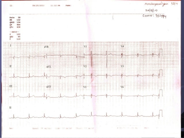 Ecg Dextrocardia Ecg Dextrocardia