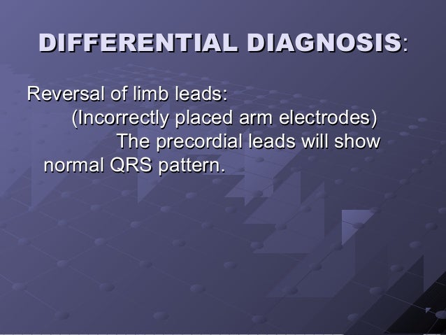 Ecg Dextrocardia Ecg Dextrocardia