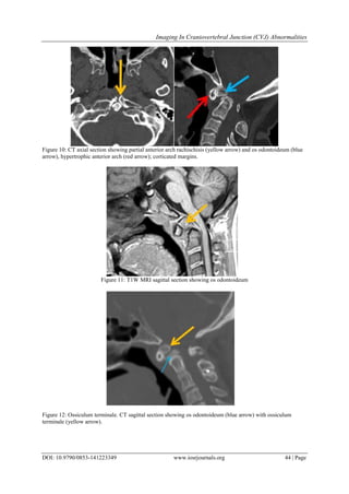 Imaging In Craniovertebral Junction (CVJ) Abnormalities | PDF