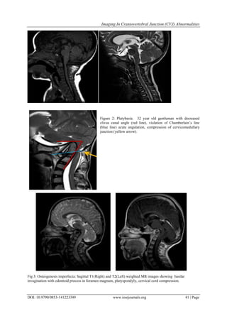 Imaging In Craniovertebral Junction (CVJ) Abnormalities | PDF
