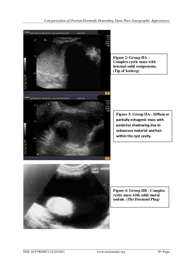 Categorization Of Ovarian Dermoids Depending Upon Their Sonographic A