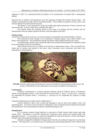 Inflammatory Conditions Mimicking Tumours In Calabar: A 30 Year Study (1978-2007).
www.iosrjournals.org 41 | Page
organism in 1882. It is contracted directly by droplets or by contamination of material that is subsequently
inhaled.
Scleroma has an insidious and spontaneous onset but progresses through three distinct clinical stages. The
nodular or granulomatous stage consists of intranasal polyps. These nodules are painless and may occur at any
location between the nostrils and the lung hila.
The disease is seen commonly in young and middle aged adults and persons of lower economic and
nutritional levels. It occurs a little more in females than males.5
The location within the maxillary antrum in this study is in keeping with the common sites for
rhinoscleroma when the nodules spread to the floor, walls and septum of the nose.6
Onchocerciasis
A parasitic infection by the onchocerca volvolus nematode is transmitted by the female blackfly, simulium.
The onchocercal larvae develop in the ensymbiotic wolbachia pipiens worm which resides in the
dermis of the human host. The microfilariae develop and mature within nodules formed by the worms.
An inflammatory reaction occurs around the adult worm and that directed against the wolbachia carried
by the microfilariae results in tissue fibrosis.7
These fibrotic lesions occur as nodules involving skin or subcutaneous tissues. They are usually non-
tender and of varying sizes located in the pelvis, lower extremities, lower extremities, and lower torso
particularly in African patients.9
FIGURE 4: Section showing gravid Onchocercal volvulus with fibrosis and hyalinization of the stroma. The
stroma is infiltrated by chronic inflammatory cells mainly eosinophils and lymphocytes.
Leishmaniasis
Cutaneous Leishmaniasis is a chronic parasitic infection caused by different species of leishmania
related to the geographic location. In the old world of Asia and Africa, L. major, L. tropica and L. aethiopica
are responsible for infection while L. braziliensis, L. mexicana etc are responsible for infection in South
America.
Cutaneous leishmaniasis may induce chronic inflammation.10
Lesions manifest in skin as dry, crusted and spreading or may be moist and exudative with a red
granulating base. A mixture of acute and chronic inflammatory cells of infected and non-infected mononuclear
cells predominate with a granulomatous response of epitheloid and giant cells.1
Histoplasmosis
It is a common systemic fungal infection in some parts of North America (mid western and south
eastern USA). The disease is caused by Histoplasma capsulatum whose varants and virulence differ with
geographic location.14
H. capsulatum var dubosii is responsible for most of the disease in Africa with Nigeria,
Senegal, Zaire and Uganda accounting for most of the cases.
Infection is acquired by inhalation of fungal spores from the soil, making the lungs the site of primary
infection. The lung lesion is a concentric mass of caseating and noncaseating granuloma with a fibrotic thick
 