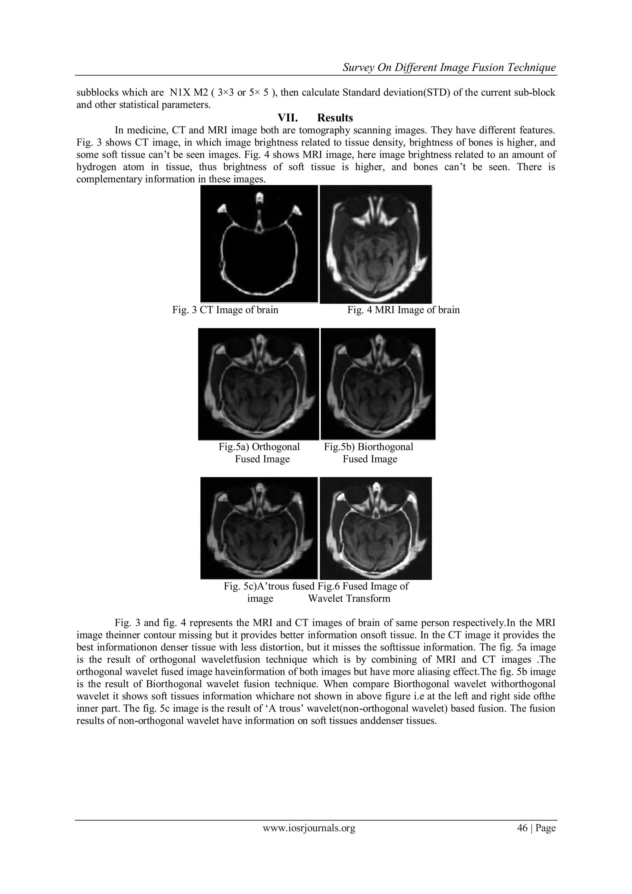 Survey On Different Image Fusion Technique
www.iosrjournals.org 46 | Page
subblocks which are N1X M2 ( 3×3 or 5× 5 ), then calculate Standard deviation(STD) of the current sub-block
and other statistical parameters.
VII. Results
In medicine, CT and MRI image both are tomography scanning images. They have different features.
Fig. 3 shows CT image, in which image brightness related to tissue density, brightness of bones is higher, and
some soft tissue can’t be seen images. Fig. 4 shows MRI image, here image brightness related to an amount of
hydrogen atom in tissue, thus brightness of soft tissue is higher, and bones can’t be seen. There is
complementary information in these images.
Fig. 3 CT Image of brain Fig. 4 MRI Image of brain
Fig.5a) Orthogonal Fig.5b) Biorthogonal
Fused Image Fused Image
Fig. 5c)A’trous fused Fig.6 Fused Image of
image Wavelet Transform
Fig. 3 and fig. 4 represents the MRI and CT images of brain of same person respectively.In the MRI
image theinner contour missing but it provides better information onsoft tissue. In the CT image it provides the
best informationon denser tissue with less distortion, but it misses the softtissue information. The fig. 5a image
is the result of orthogonal waveletfusion technique which is by combining of MRI and CT images .The
orthogonal wavelet fused image haveinformation of both images but have more aliasing effect.The fig. 5b image
is the result of Biorthogonal wavelet fusion technique. When compare Biorthogonal wavelet withorthogonal
wavelet it shows soft tissues information whichare not shown in above figure i.e at the left and right side ofthe
inner part. The fig. 5c image is the result of ‘A trous’ wavelet(non-orthogonal wavelet) based fusion. The fusion
results of non-orthogonal wavelet have information on soft tissues anddenser tissues.
 