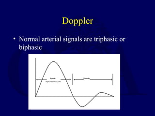 Doppler
• Normal arterial signals are triphasic or
biphasic
 