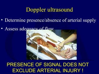 Doppler ultrasound
• Determine presence/absence of arterial supply
• Assess adequacy of flow
PRESENCE OF SIGNAL DOES NOT
EXCLUDE ARTERIAL INJURY !
 
