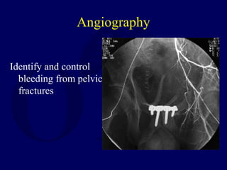 Angiography
Identify and control
bleeding from pelvic
fractures
 