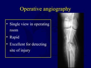 Operative angiography
• Single view in operating
room
• Rapid
• Excellent for detecting
site of injury
 