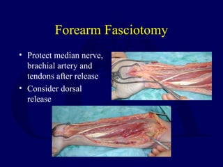 Forearm Fasciotomy
• Protect median nerve,
brachial artery and
tendons after release
• Consider dorsal
release
 